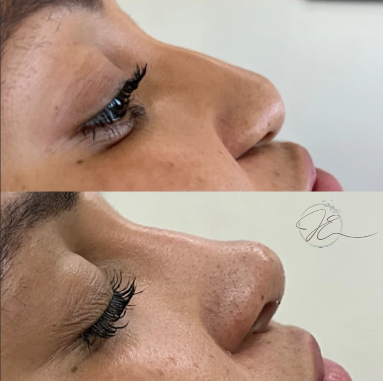 Antes e depois de rinomodelação (perfil)