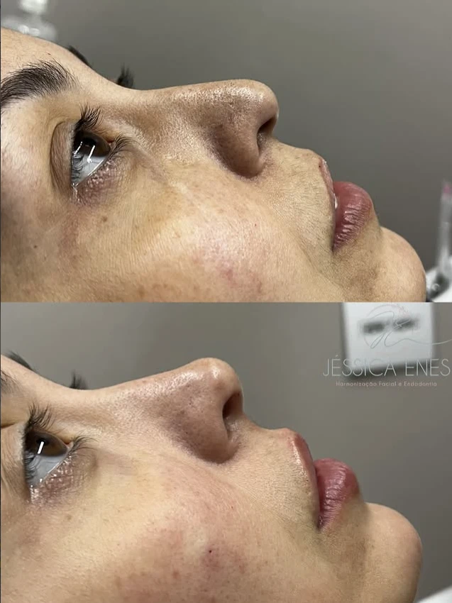 Antes e depois de rinomodelação (perfil)