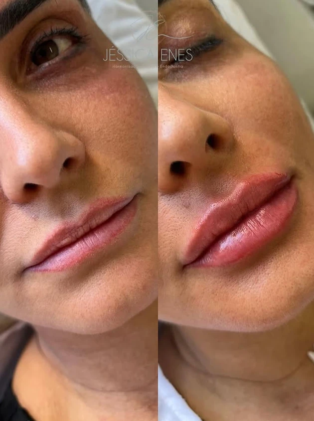Antes e depois de preenchimento labial